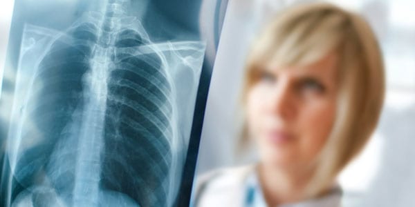 exposición al asbesto y caso de mesotelioma abogado lopez